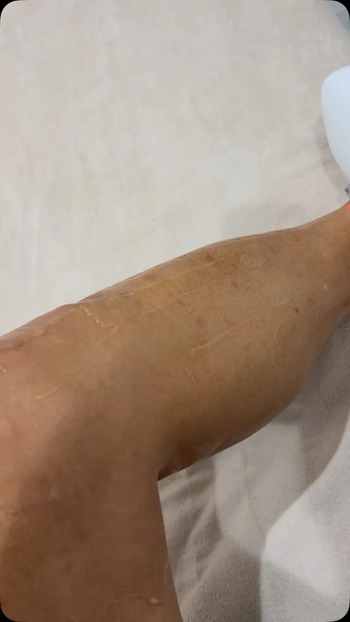 🔥 男の脱毛、まだ悩んでる？